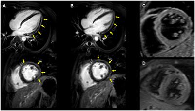 Case Report: Myocarditis Associated With COVID-19 mRNA Vaccination Following Myocarditis Associated With Campylobacter Jejuni